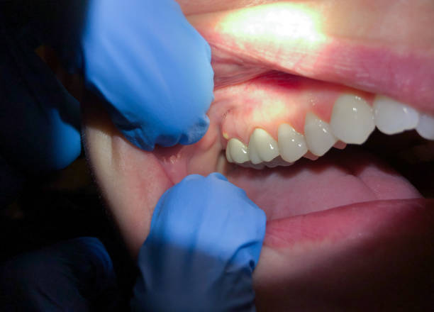 Best Emergency Dentist for Lost Fillings or Crowns in Pistakee Highlands, IL